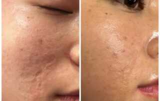 scar treatment co2 laser treatment near me