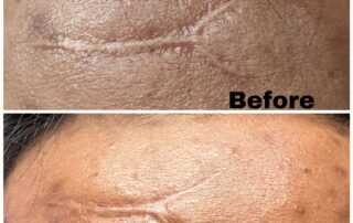 scar treatment co2 laser treatment near me after 1 session