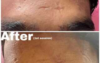 scar treatment co2 laser treatment after 1 session