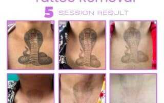tattoo removal after 5th session