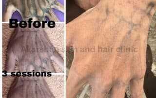 tattoo removal after 4th session