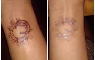 tattoo removal after 1 st session