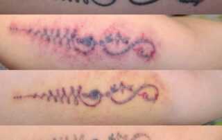 tattoo removal 4 session results