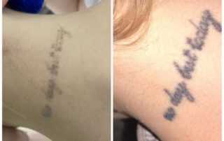 tattoo removal after 1 session results