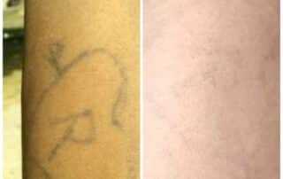 tattoo removal in kathmandu