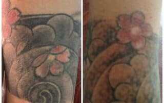 tattoo removal 1st session