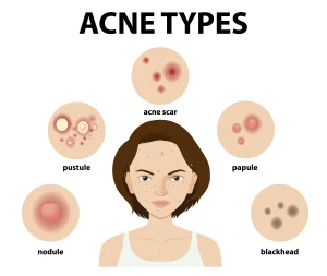 Acne & Acne Scar Removal and types in kathmandu
