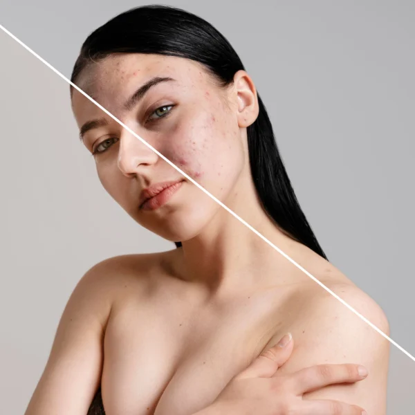 Acne & Acne Scar Removal for female in kathmandu