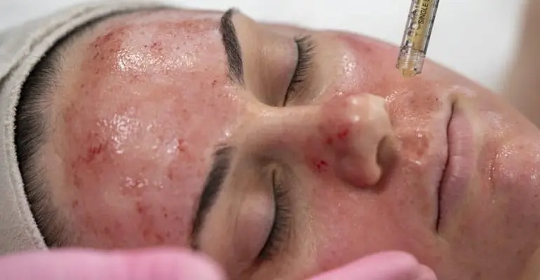 PRP Micro Needle Therapy with microneedling treatment in nepal
