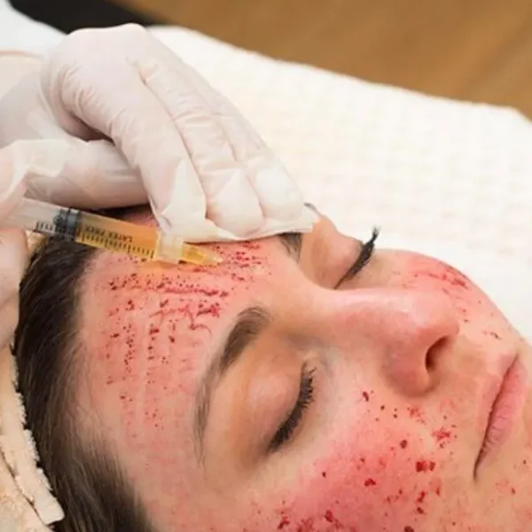 Vampire Facial treatment in kathmandu