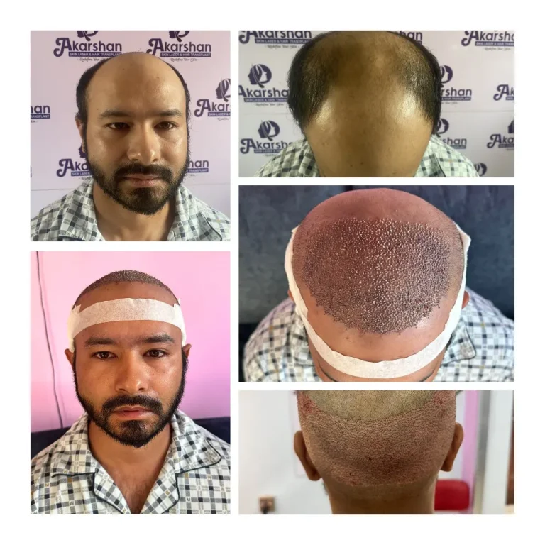 Ashish Munankarmi 4000 graft surgery day hair transplant