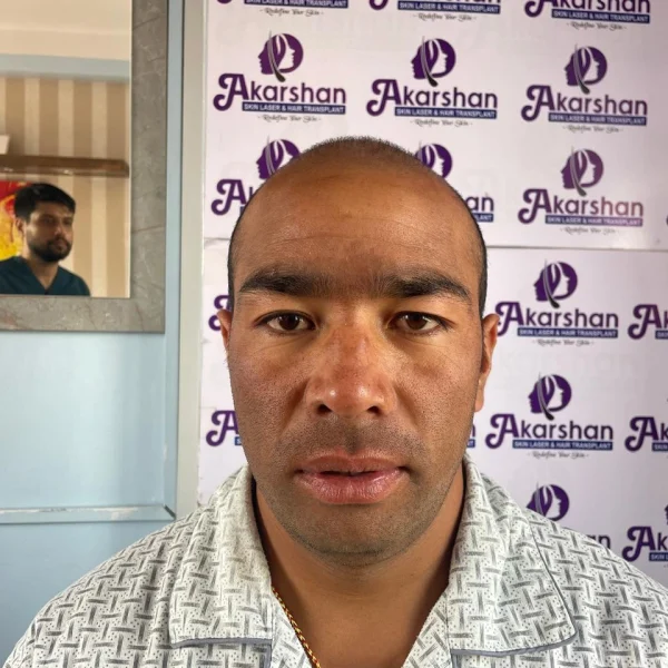 hair transplant before