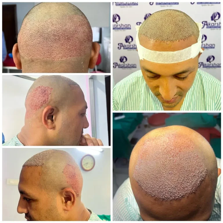 hair transplant surgery day