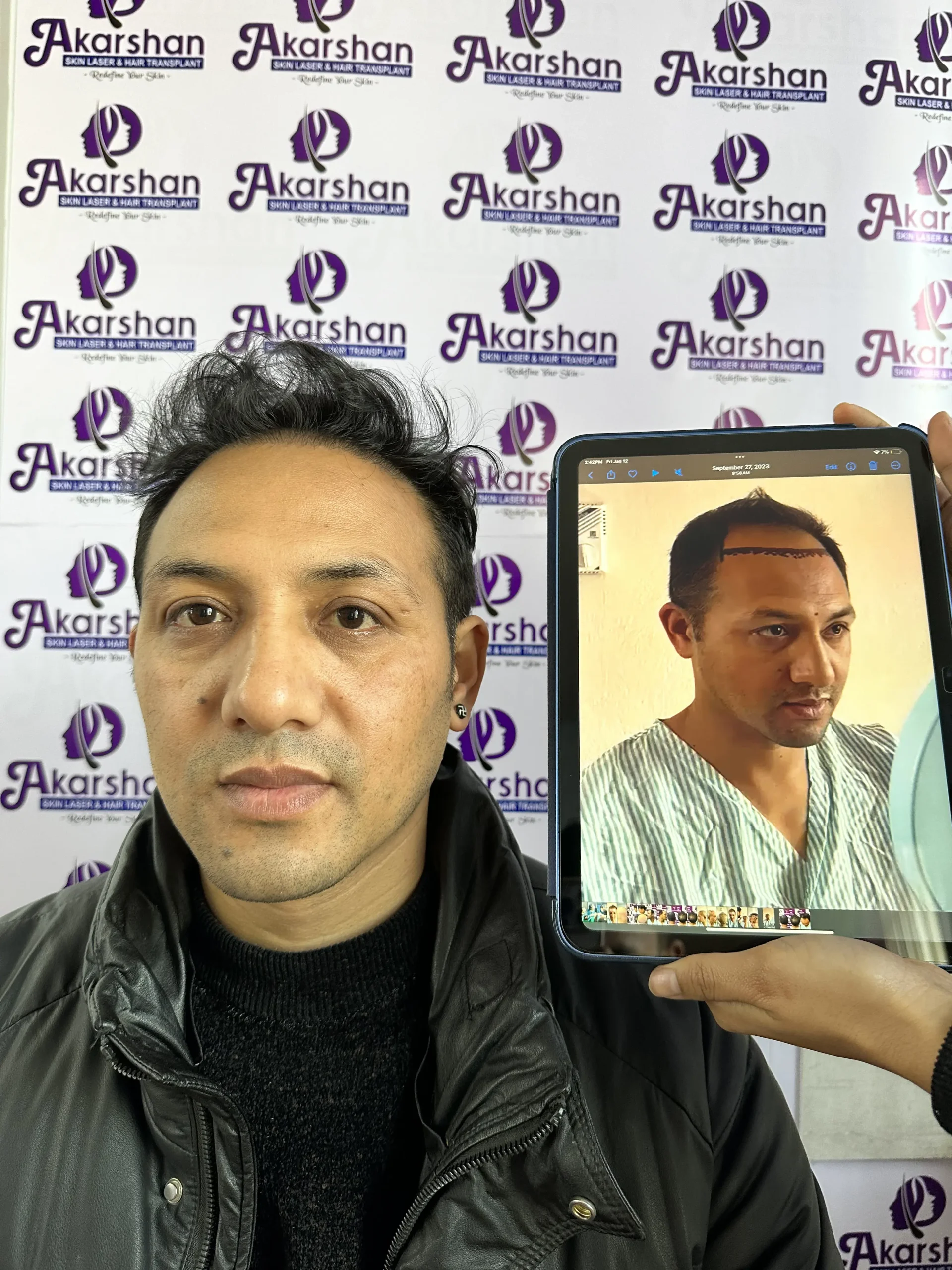 before and after result of hair transplant