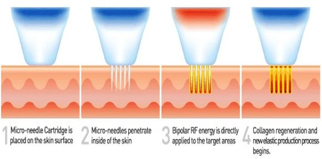 MNRF-process