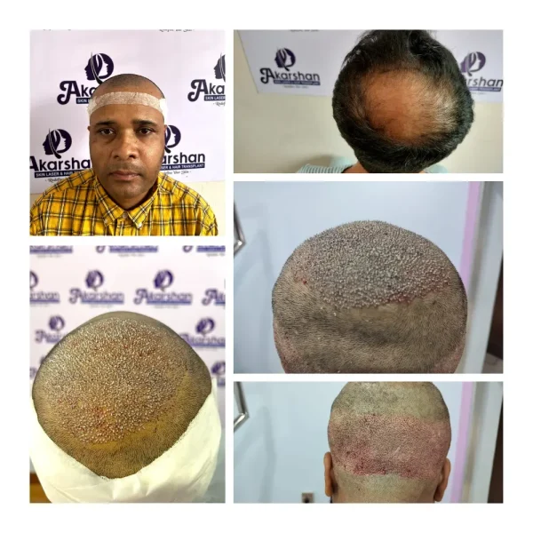 Nirman 3500 graft crown area