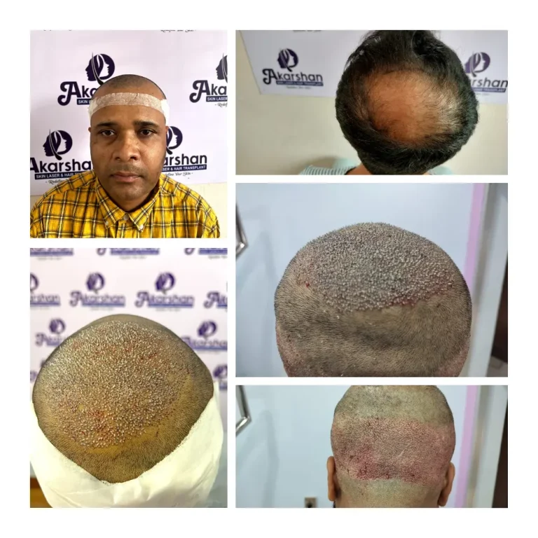 FUE Hair Transplant: Crown Area Restoration 3500 graft surgery day