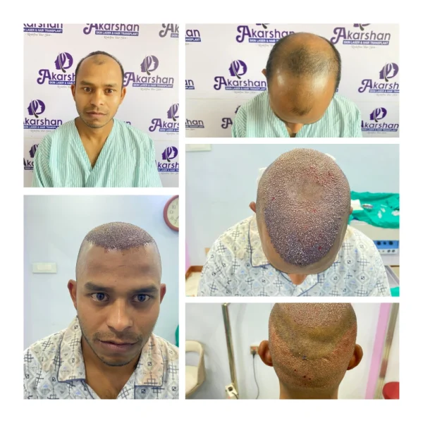 SALIN 5000 graft