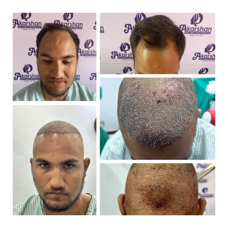 SHISHIR 3000 graft surgery day 3000 graft dht