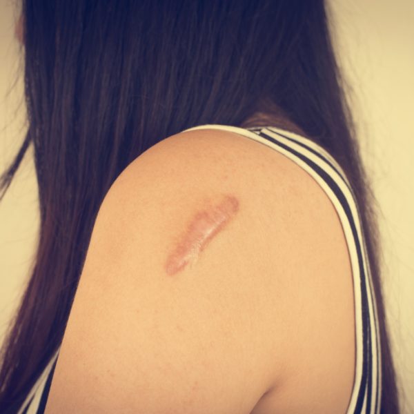 Scar Revision Surgery in kathmandu Cost Treatment