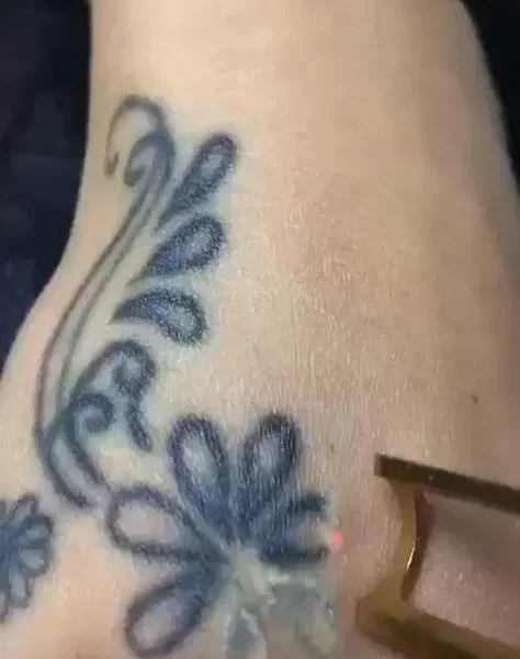 Tattoo Removal in kathmandu