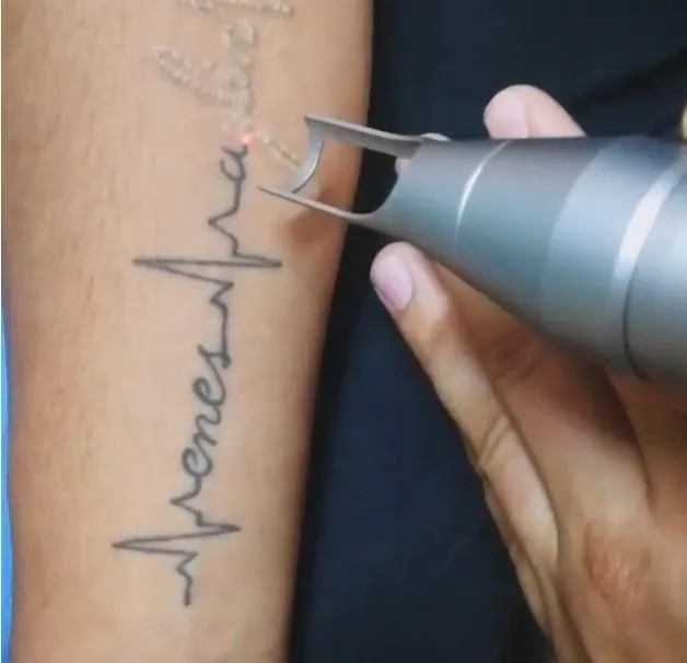 Tattoo Removal in kathmandu Procedures and Cost Akarshan Clinic