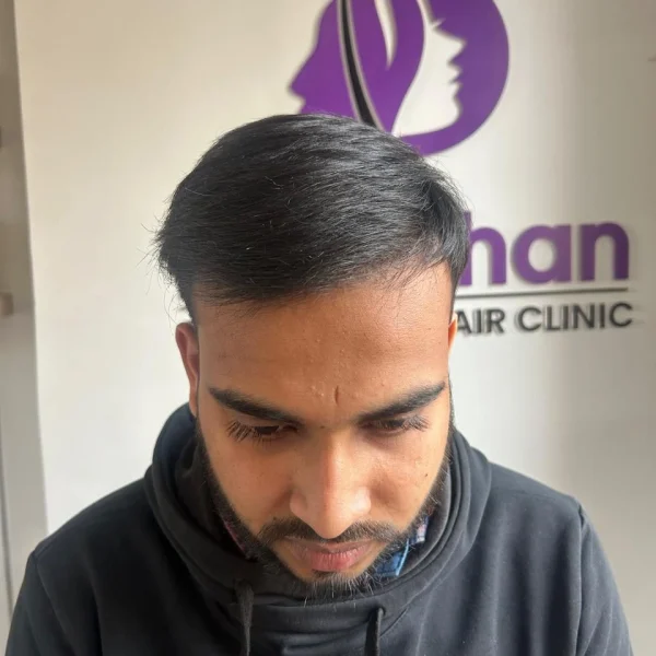 after hair transplant 3200 graft dht 6 month results