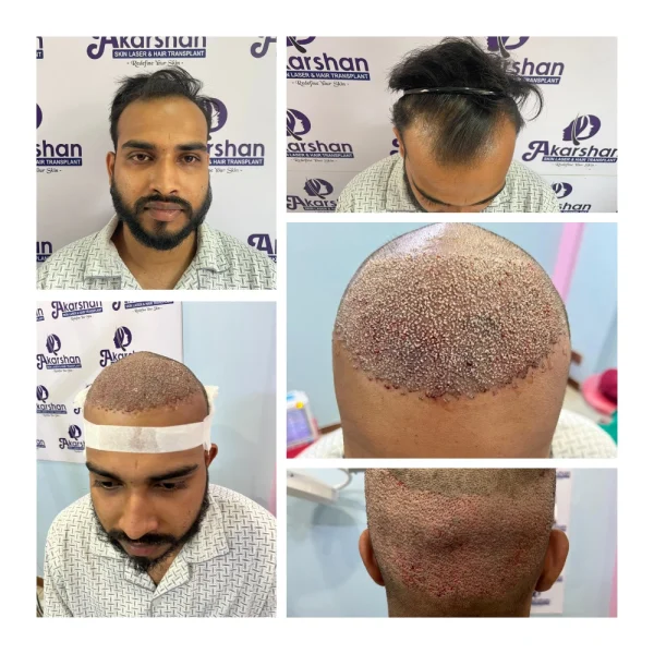 aman hair transplant 3200 graft dht surgery day