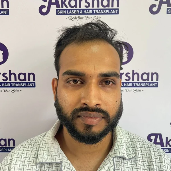 before hair transplant 3200 graft dht