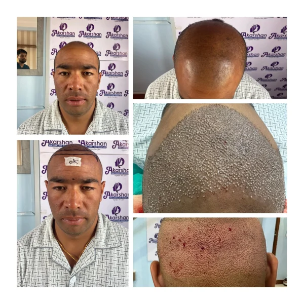 bil thami 3000 graft fue surgery day
