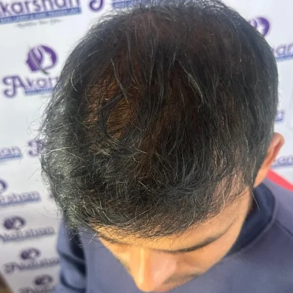 hair-transplant-after-1-year-photo-3000-graft-2-1-e1773996479748-600x638