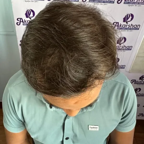 hair-transplant-after-1-year-photo-3000-graft-2-e1773996086432-600x616