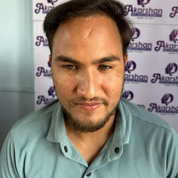 hair-transplant-after-1-year-photo-3000-graft-e1773996045928-600x643