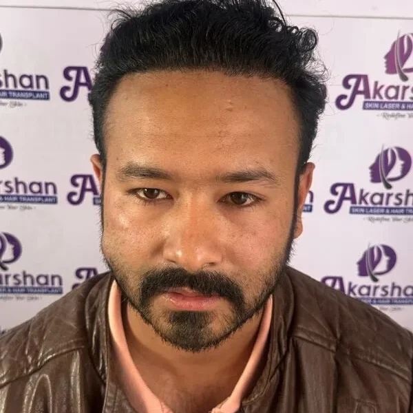 hair-transplant-after-1-year-photo-4000-graft-e1773996991426-600x619