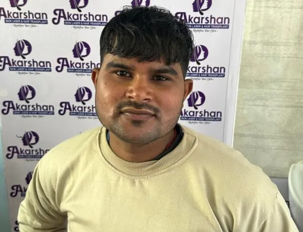 hair-transplant-after-1-years-photo-3500-graft-e1773995605765-600x459
