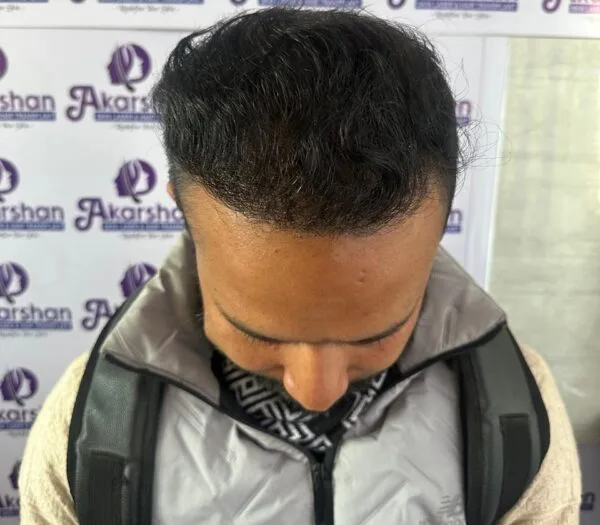 hair-transplant-after-6-months-photo-4000-graft-e1773997029377-600x525