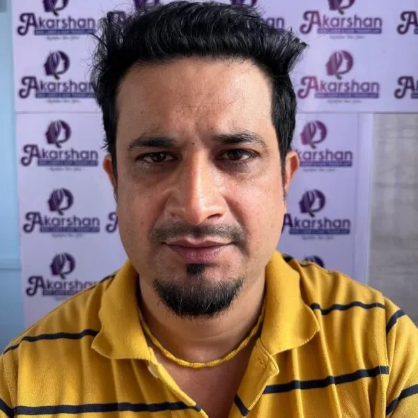 hair-transplant-after-6-months-photo-5000-graft-e1773995101941-600x624