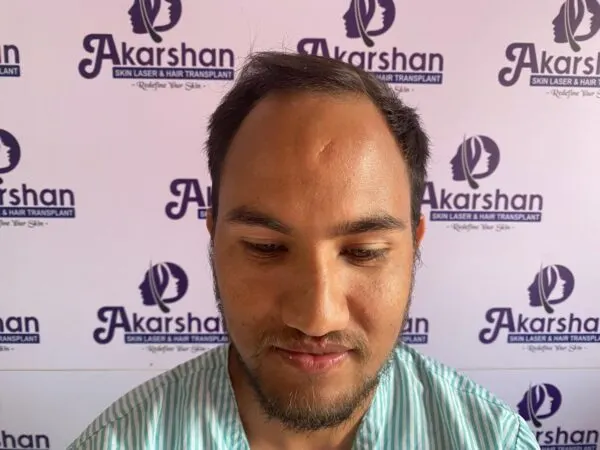 hair-transplant-before-photo-3000-graft-600x450