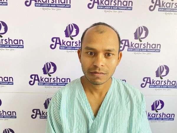 hair-transplant-before-photo-3500-graft-1-600x450