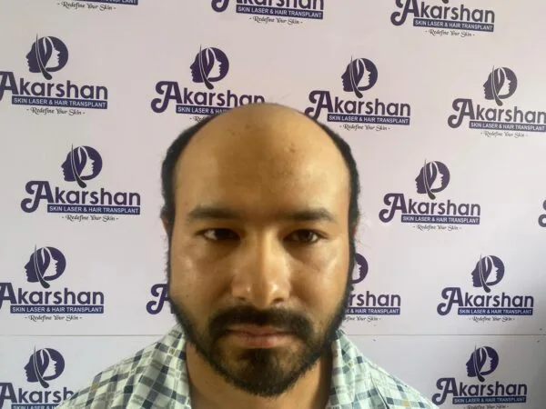 hair-transplant-before-photo-4000-graft-600x450