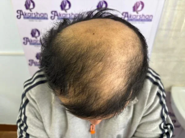hair-transplant-before-photo-5000-graft-600x450