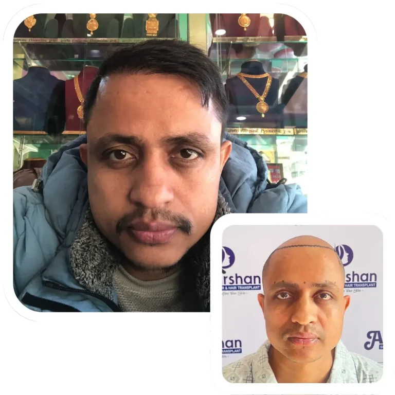 hair transplant result before and after 1 year
