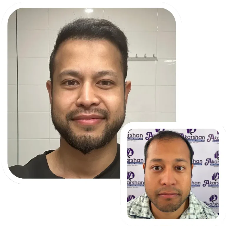 hair transplant result before and after 1.2 years