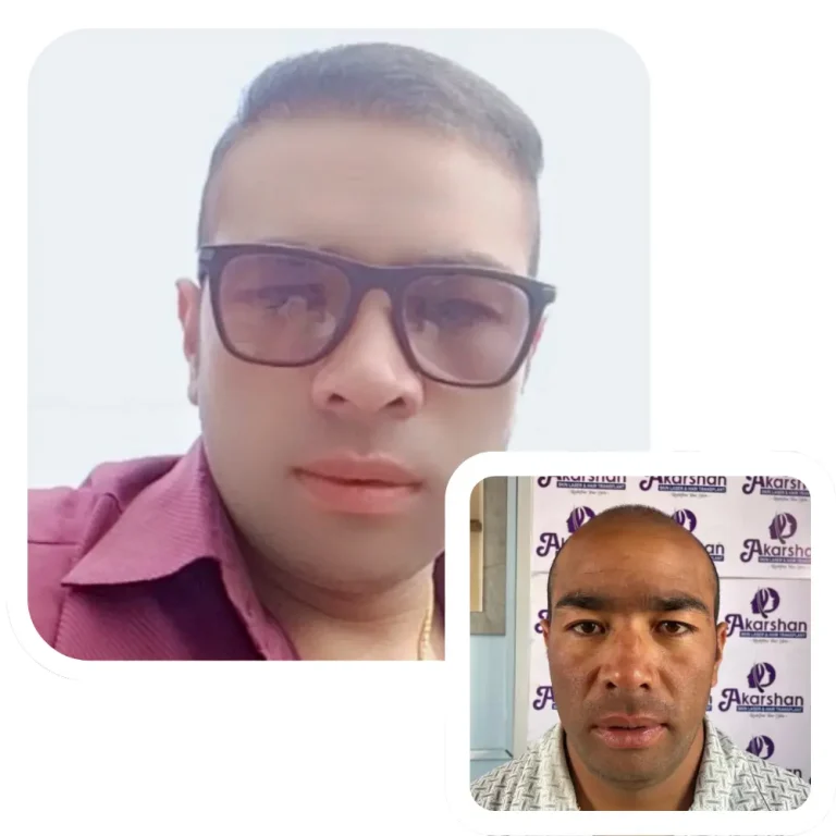 hair transplant result before and after 3 month