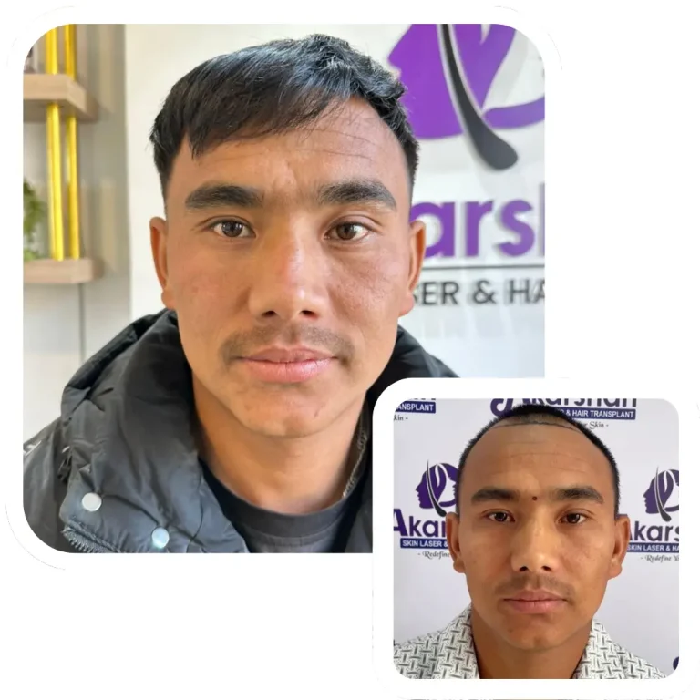 hair transplant result before and after 12 month