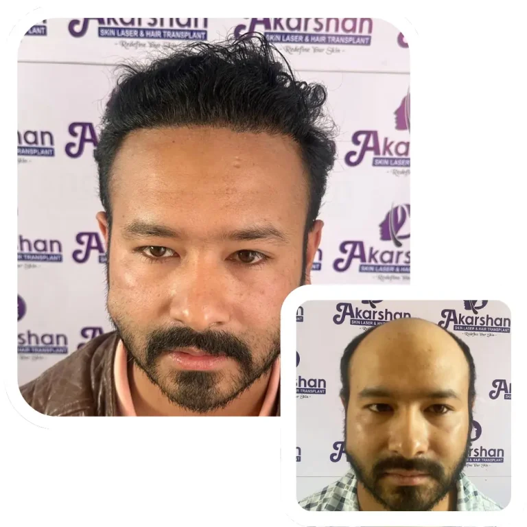 hair transplant result before and after 12 month