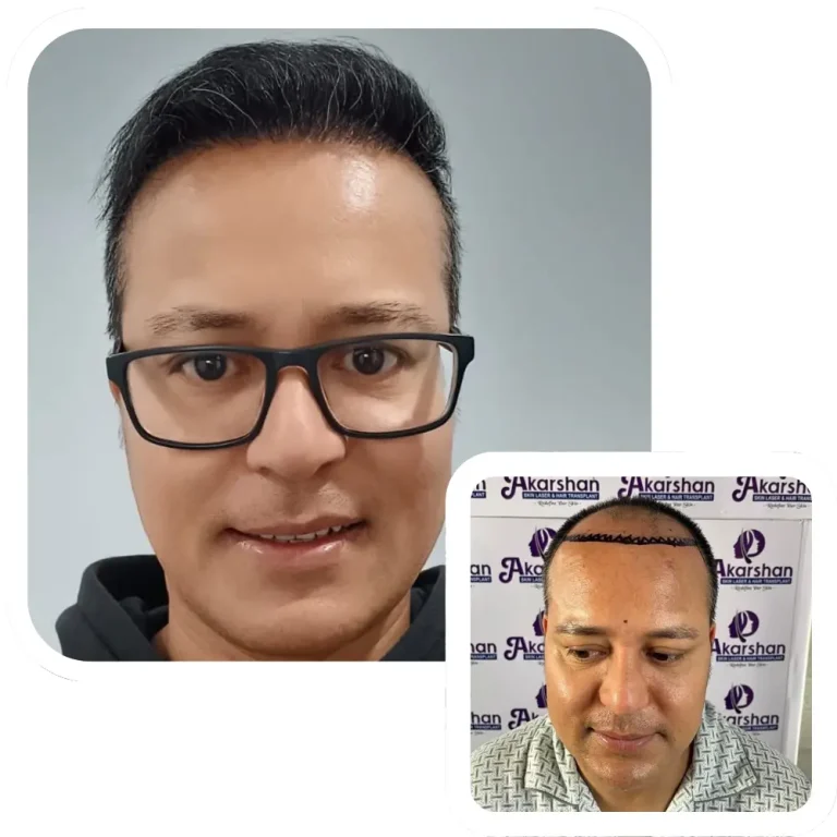 hair transplant result before and after