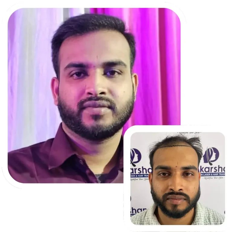 hair transplant result before and after 8 month