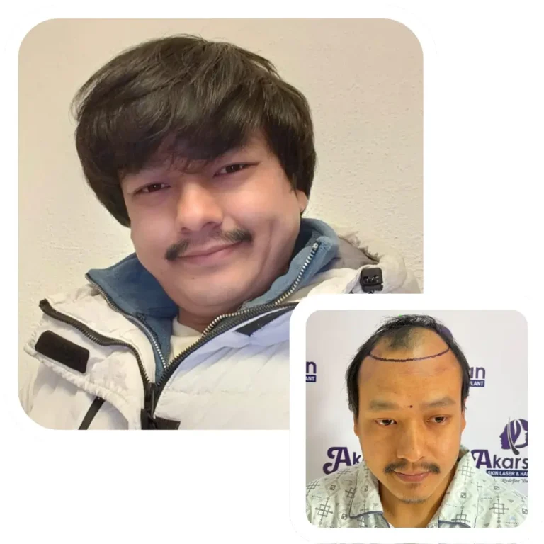 hair transplant result before and after 12 month