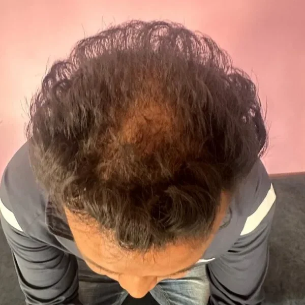 hair-transplnat-after-photo-crown-area-3000-graft-600x800